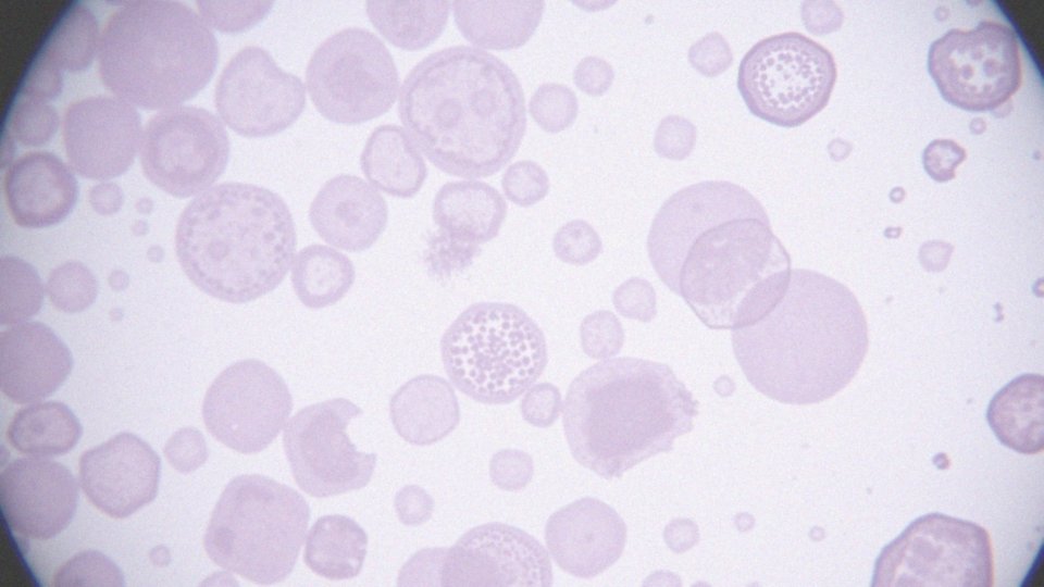 Jakie zmiany są typowe po radioterapii i chemioterapii?
